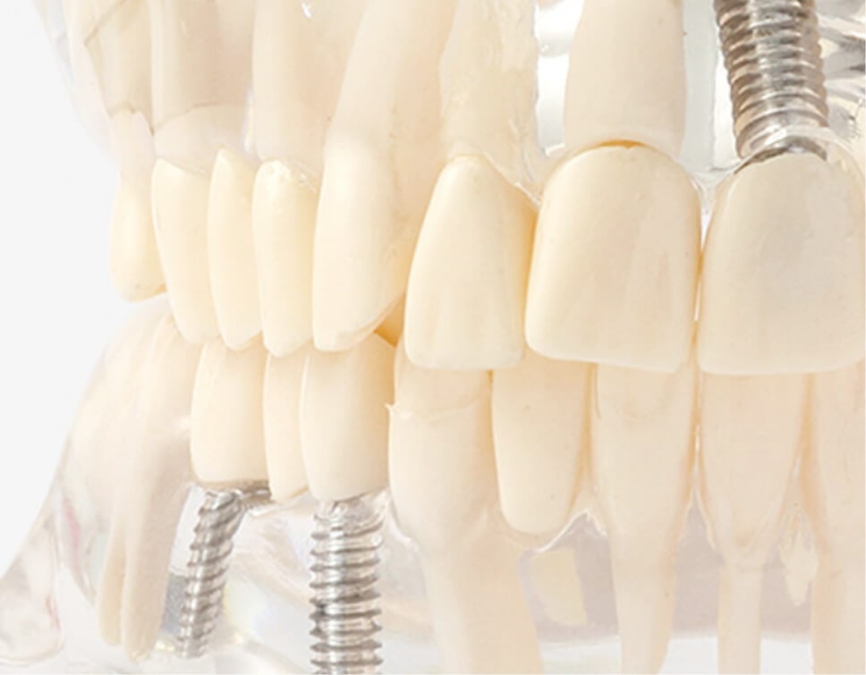 IMPLANT インプラント